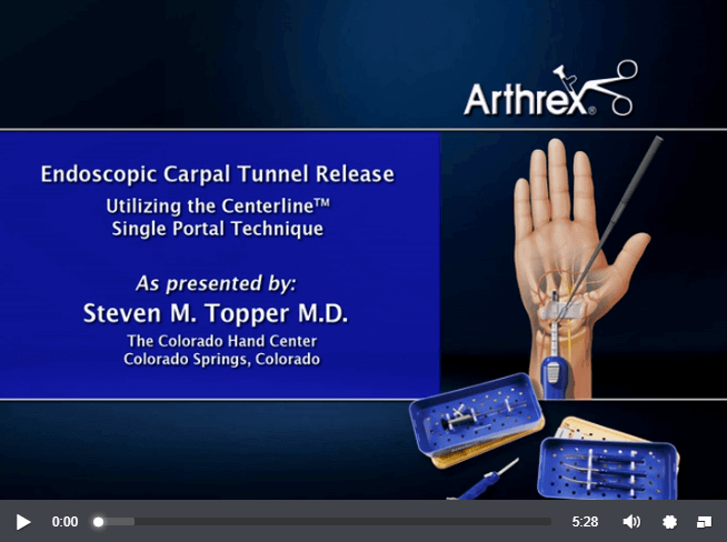 Endoscopic carpal tunnel release video, showing key-hole carpal tunnel release surgery. | Dr James McLean | Orthopaedic Surgeon | ASULC | Adelaide
