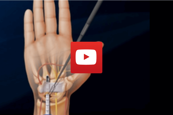 Endoscopic Carpal Tunnel Release | Dr James McLean | Orthopaedic Surgeon | ASULC | Adelaide