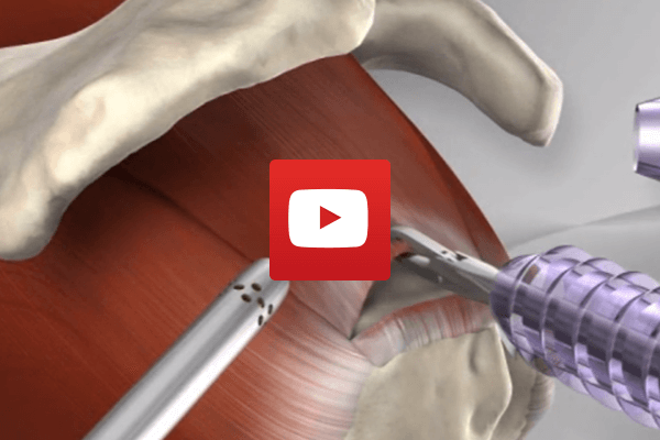 Knotless Rotator Cuff Repair with Arthrex SpeedFix | Dr James McLean | Orthopaedic Surgeon | ASULC | Adelaide