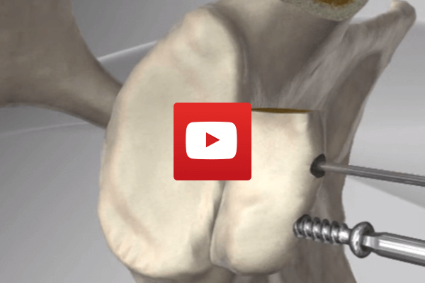 Latarjet for Instability | Dr James McLean | Orthopaedic Surgeon | ASULC | Adelaide