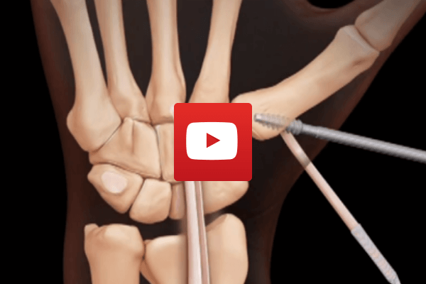 Thumb Arthritis Surgery Video Thumbnail
