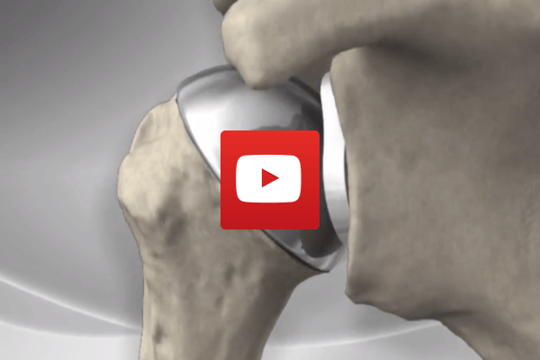 Shoulder-Replacement-Animation | Dr James McLean | Orthopaedic Surgeon | ASULC | Adelaide
